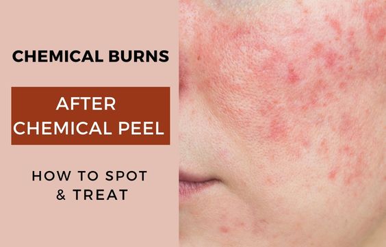 Chemical Burns After Chemical Peel - How to Spot & Treat