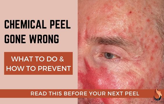 Chemical Peel Gone Wrong – What to Do & How to Prevent