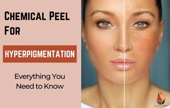Chemical Peel For Hyperpigmentation - Ultimate Guide