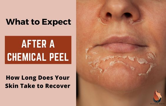What to Expect After a Chemical Peel & When Do You Recover