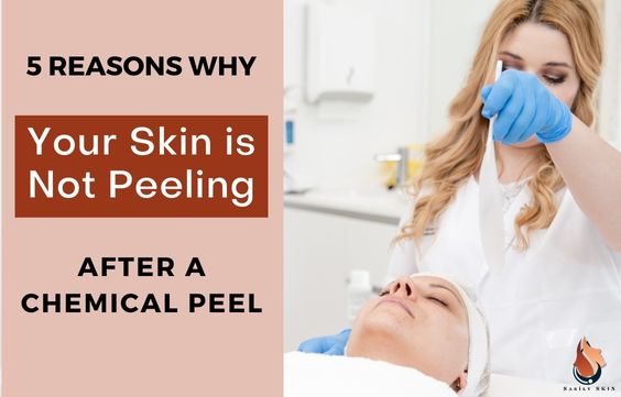 Why Your Skin is Not Peeling After a Chemical Peel & What to Do