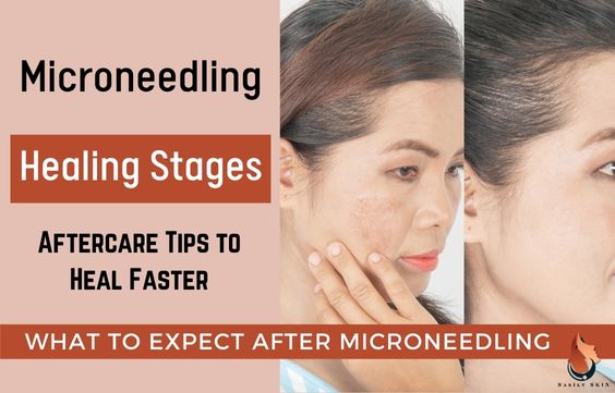 Microneedling Healing Stages & Aftercare Tips to Heal Fast