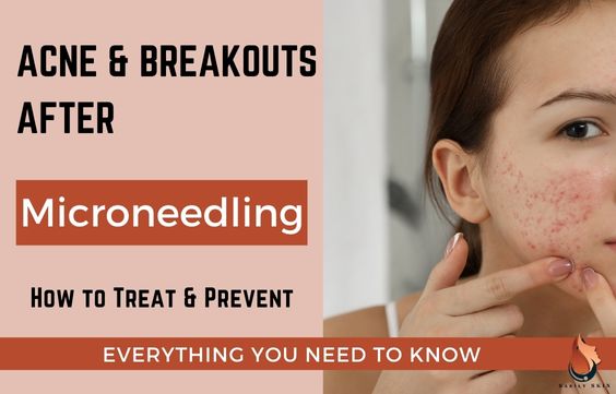 Acne & Breakouts After Microneedling – How to Treat