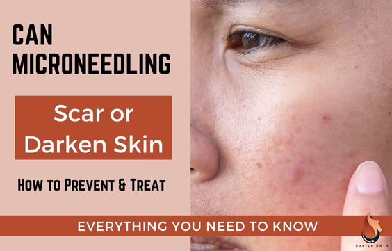 Can Microneedling Scar or Darken Skin (Hyperpigmentation)