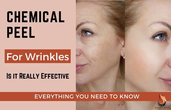 Chemical Peel For Wrinkles - Everything You Need to Know