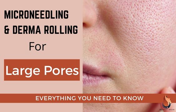 Microneedling & Derma Rolling for Large Pores - Full Guide