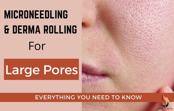 Microneedling & Derma Rolling for Large Pores - Full Guide - Sasily Skin