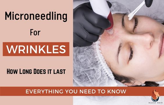 Microneedling For Wrinkles – Everything You Need to Know