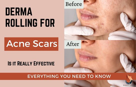 Derma Rolling for Acne Scars – Everything You Should Know