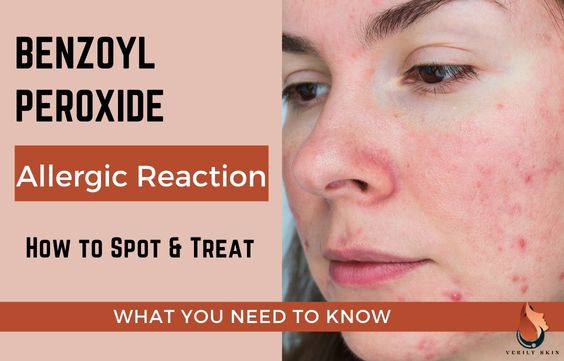 Benzoyl Peroxide Allergy: How To Spot & Treat
