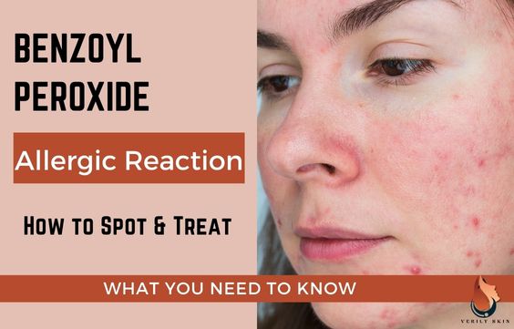 benzoyl-peroxide-allergy-how-to-spot-treat-sasily-skin