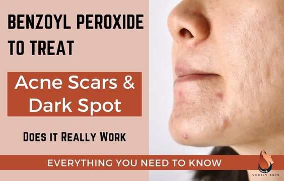 Benzoyl Peroxide To Treat Acne Scars & Dark Spots