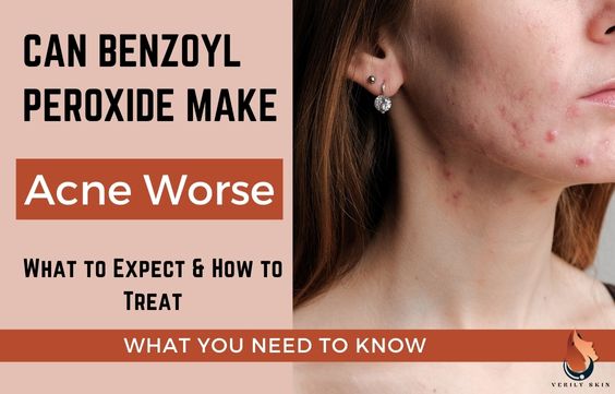 Can Benzoyl Peroxide Make Acne Worse: What To Expect & Do