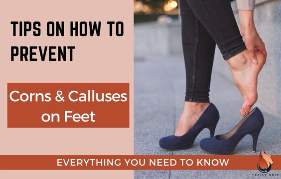 Tips on How to Prevent Calluses & Corns on Your Feet