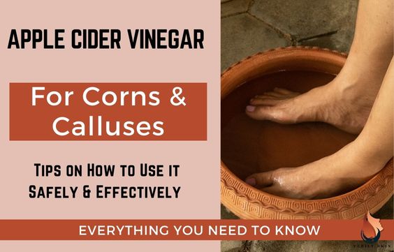 Apple Cider Vinegar For Corns & Calluses - What To Know
