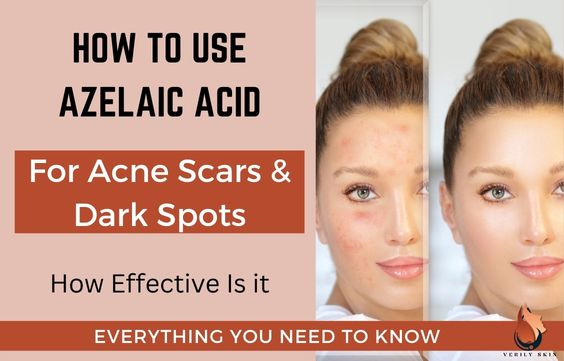 How to Use Azelaic Acid for Acne Scars & Dark Spots
