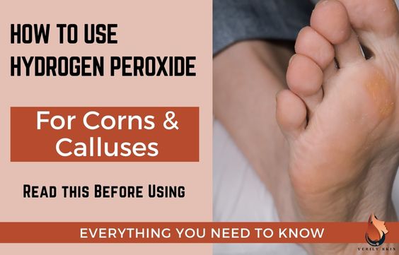 Hydrogen Peroxide for Corns & Calluses: How to Safely Use