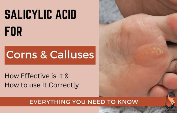 Salicylic Acid for Calluses & Corns: What You Need to Know