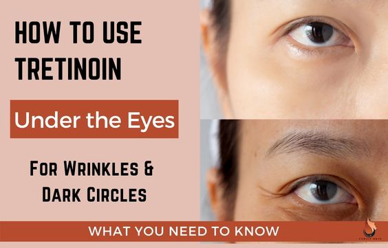 Tretinoin For Under Eye Circles & Wrinkles: What to Know