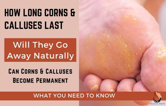 How Long Calluses & Corns Last & Do They Go Away Naturally