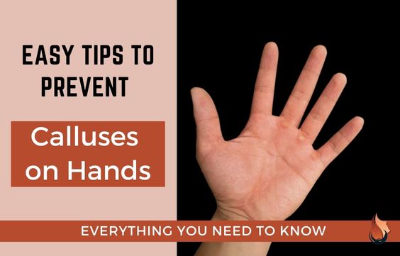 Tips on How to Prevent Calluses on Your Hands 
