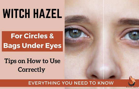 Witch Hazel for Under Eyes- Dark Circles, Bags & Puffiness