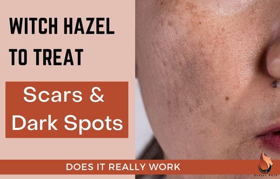 Can Witch Hazel Treat Scars & Dark Spots -What to Know