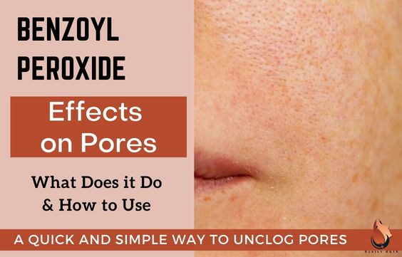 Effects of Benzoyl Peroxide on Pores: What You Need to Know