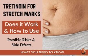 Tretinoin for Stretch Marks: Does it Really Work & Risks - Sasily Skin