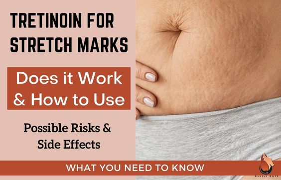 Tretinoin for Stretch Marks -Does it Work, How to Use & Risks