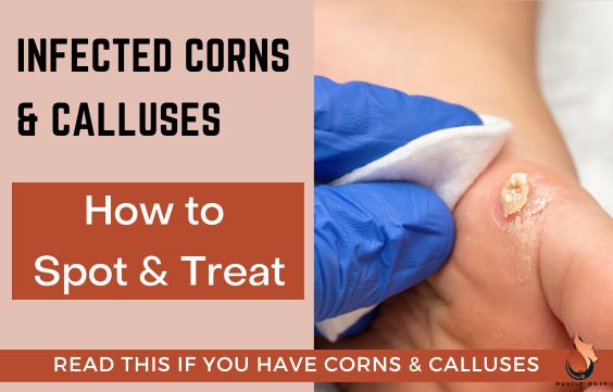 Infected Corns & Calluses - How To Spot & Treat