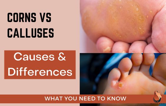 Corns vs Calluses - Causes & Differences