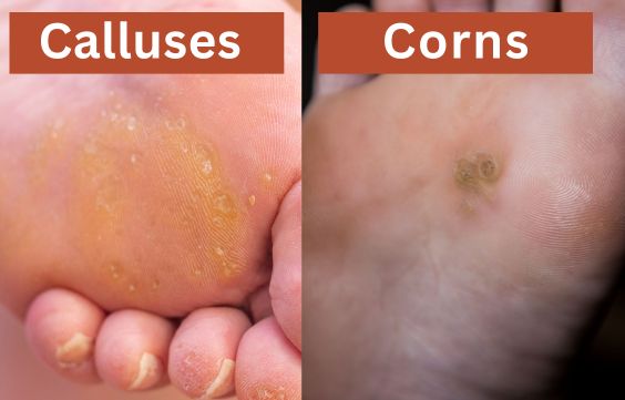 Difference between corns and calluses