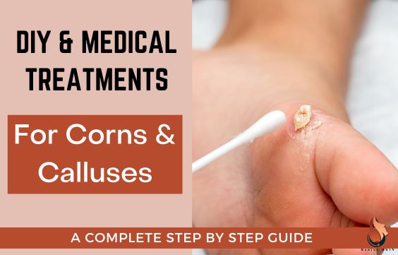Quick Remedies & Medical Treatments for Corns & Calluses