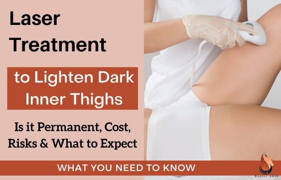 Laser Treatment For Dark Inner Thighs – What to Know