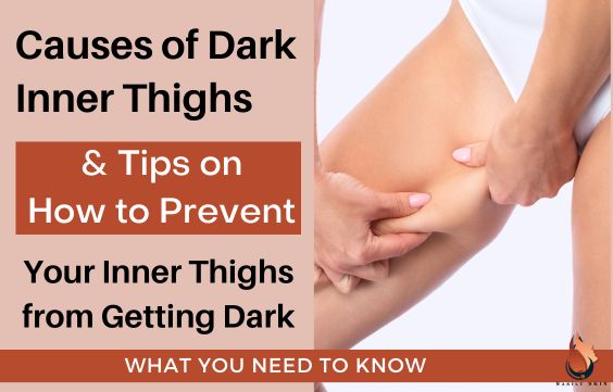 Causes of Dark Inner Thighs & Tips to Prevent