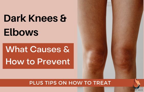 What Causes Dark Knees & Elbows & How to Prevent