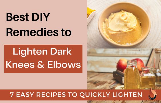 7 Best DIY Remedies For Dark Knees & Elbows
